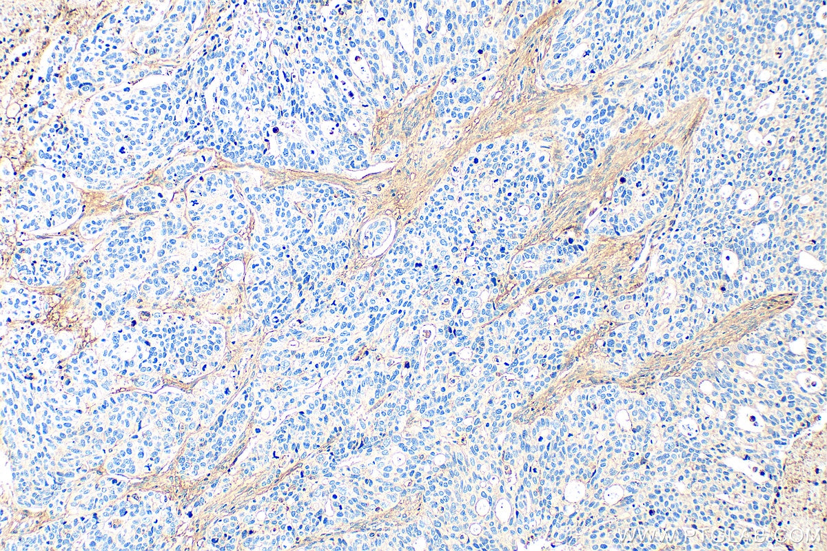 Immunohistochemical analysis of paraffin-embedded human ovary tumor tissue slide using 25474-1-AP (CTGF antibody) at dilution of 1:400 (under 10x lens). Heat mediated antigen retrieval with Tris-EDTA buffer (pH 9.0). Immunohistochemistry (IHC) staining of human ovary tumor tissue using CTGF Polyclonal antibody (25474-1-AP)