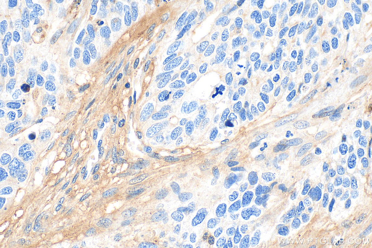 Immunohistochemical analysis of paraffin-embedded human ovary tumor tissue slide using 25474-1-AP (CTGF antibody) at dilution of 1:400 (under 40x lens). Heat mediated antigen retrieval with Tris-EDTA buffer (pH 9.0). Immunohistochemistry (IHC) staining of human ovary tumor tissue using CTGF Polyclonal antibody (25474-1-AP)
