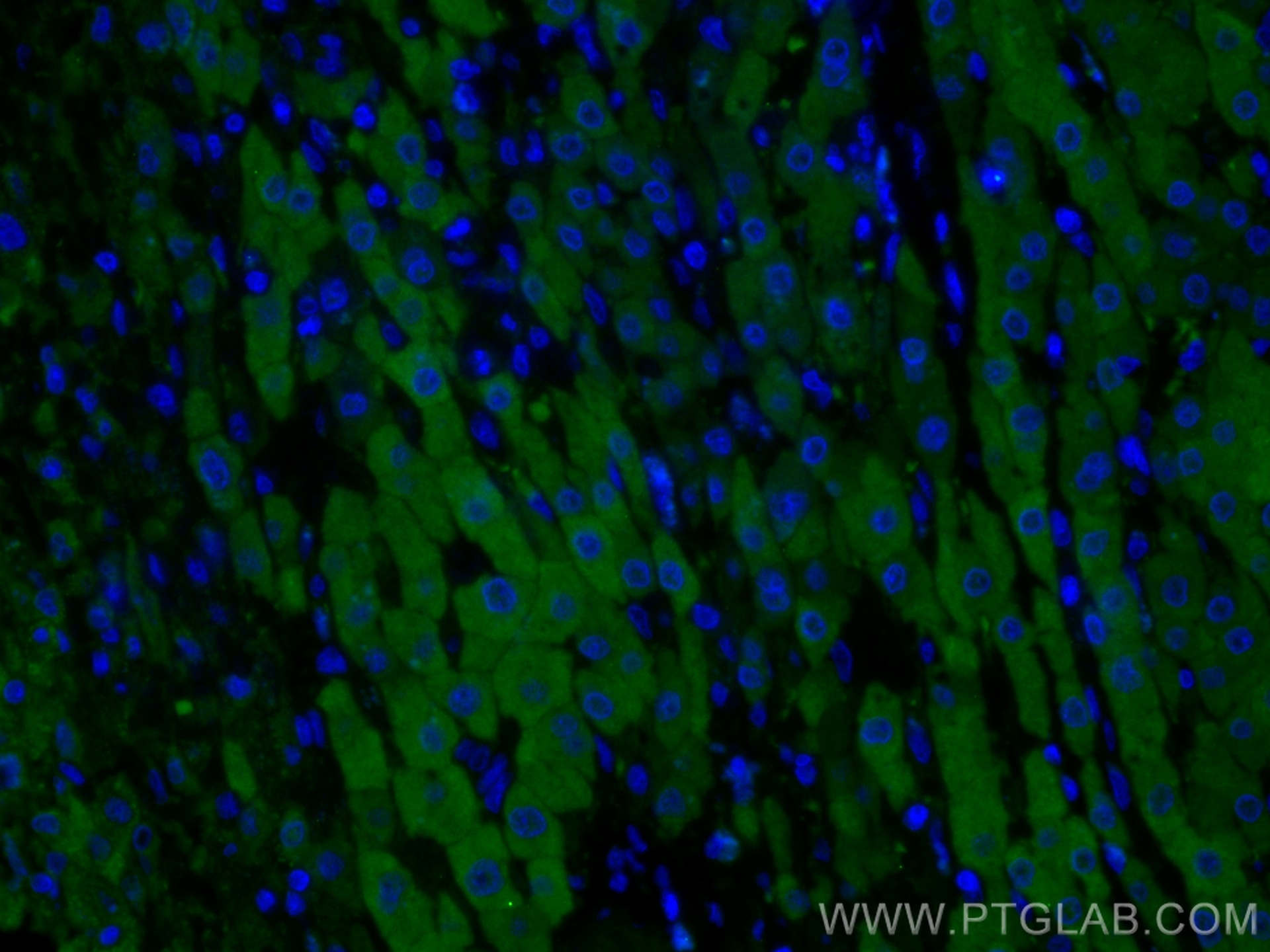 Immunofluorescence (IF) / fluorescent staining of human liver cancer tissue using Gamma Cystathionase Polyclonal antibody (12217-1-AP)