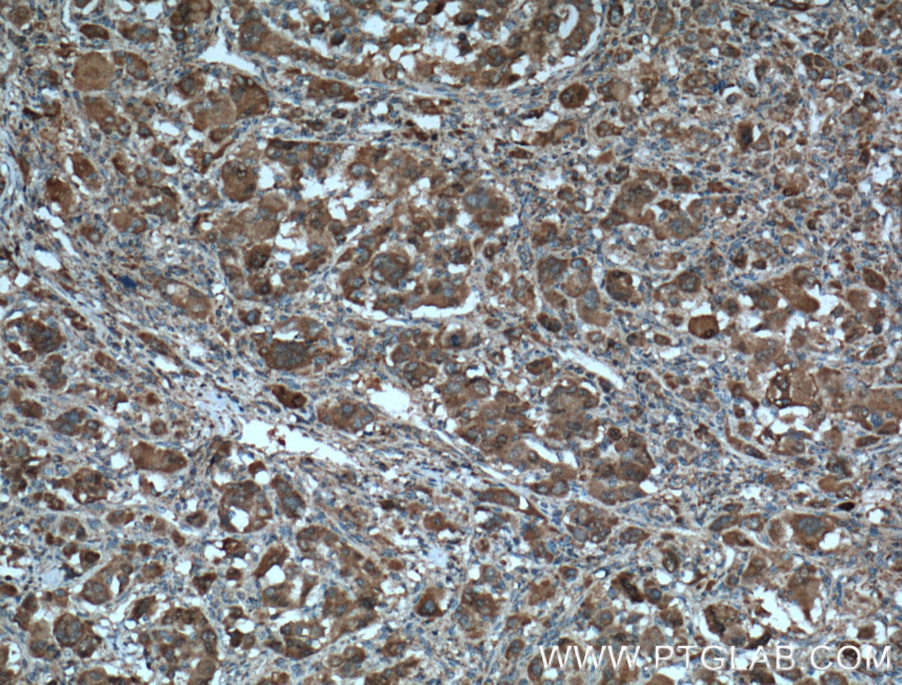 Immunohistochemistry (IHC) staining of human liver cancer tissue using Gamma Cystathionase Polyclonal antibody (12217-1-AP)