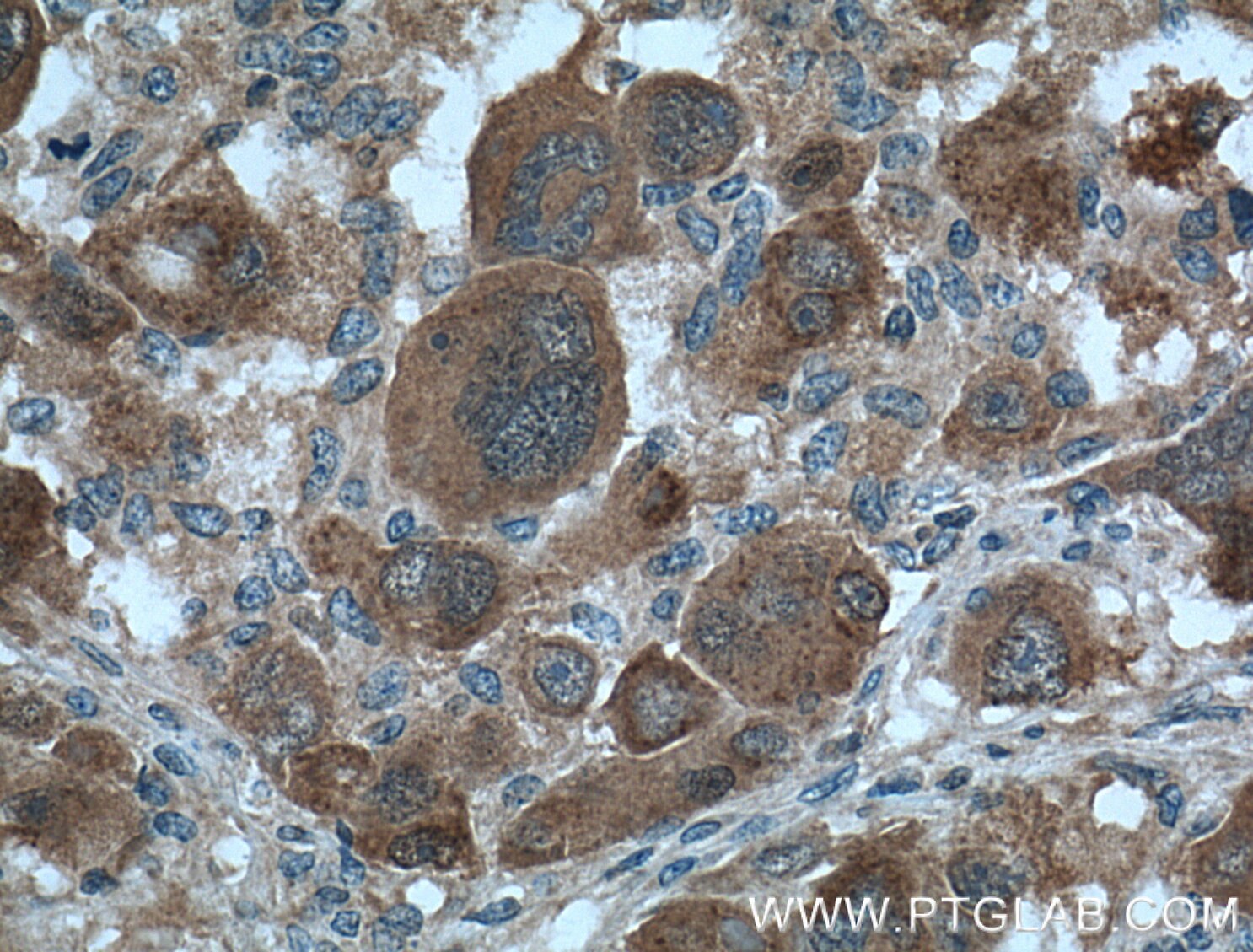 Immunohistochemistry (IHC) staining of human liver cancer tissue using Gamma Cystathionase Polyclonal antibody (12217-1-AP)