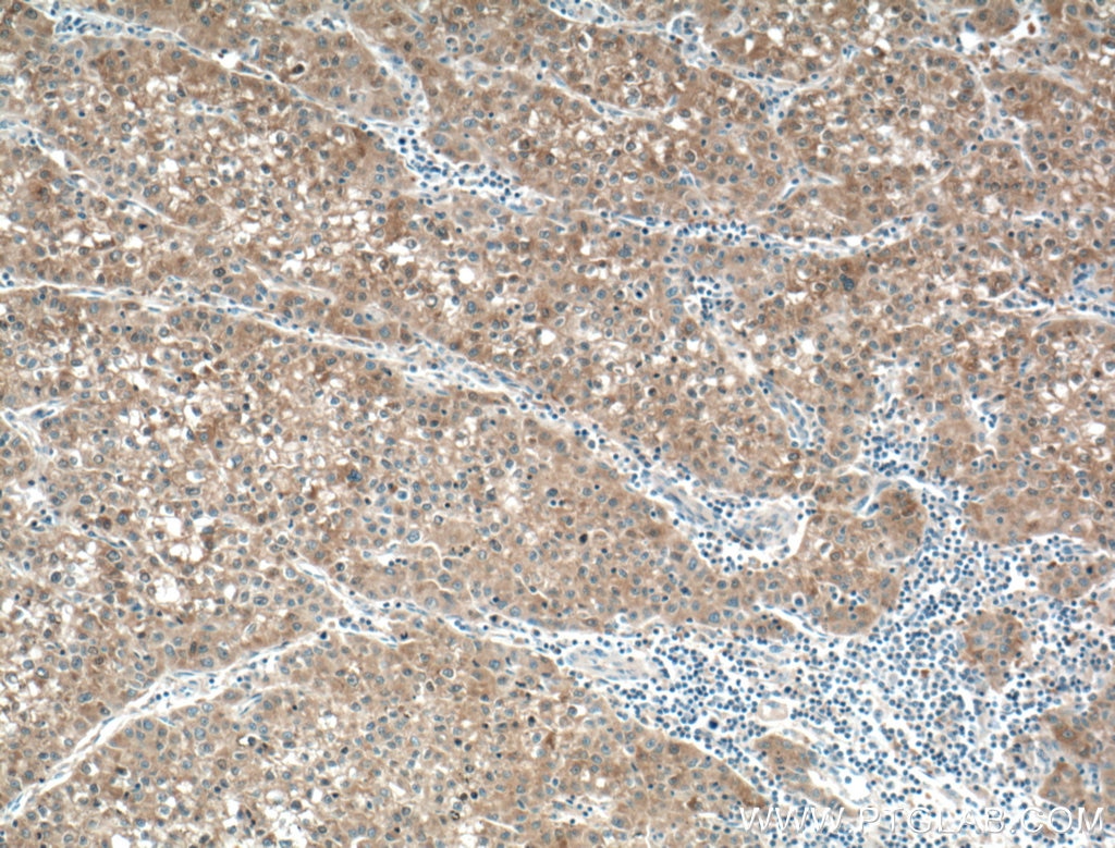 Immunohistochemistry (IHC) staining of human liver cancer tissue using Gamma Cystathionase Polyclonal antibody (12217-1-AP)