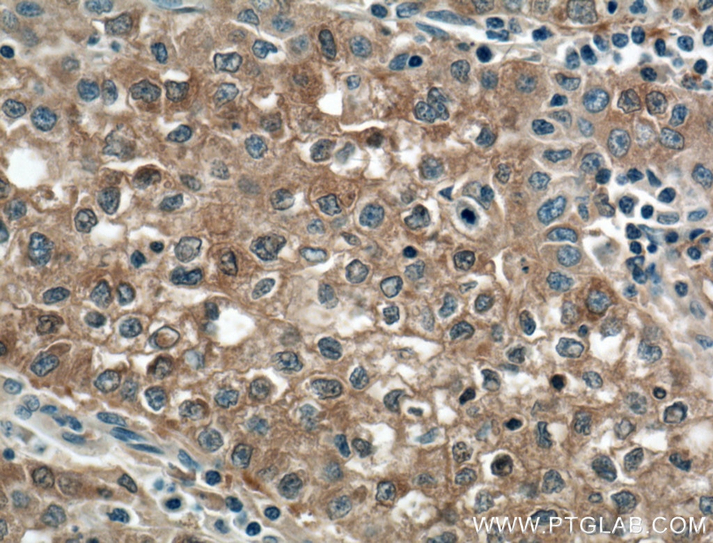 Immunohistochemistry (IHC) staining of human liver cancer tissue using Gamma Cystathionase Polyclonal antibody (12217-1-AP)
