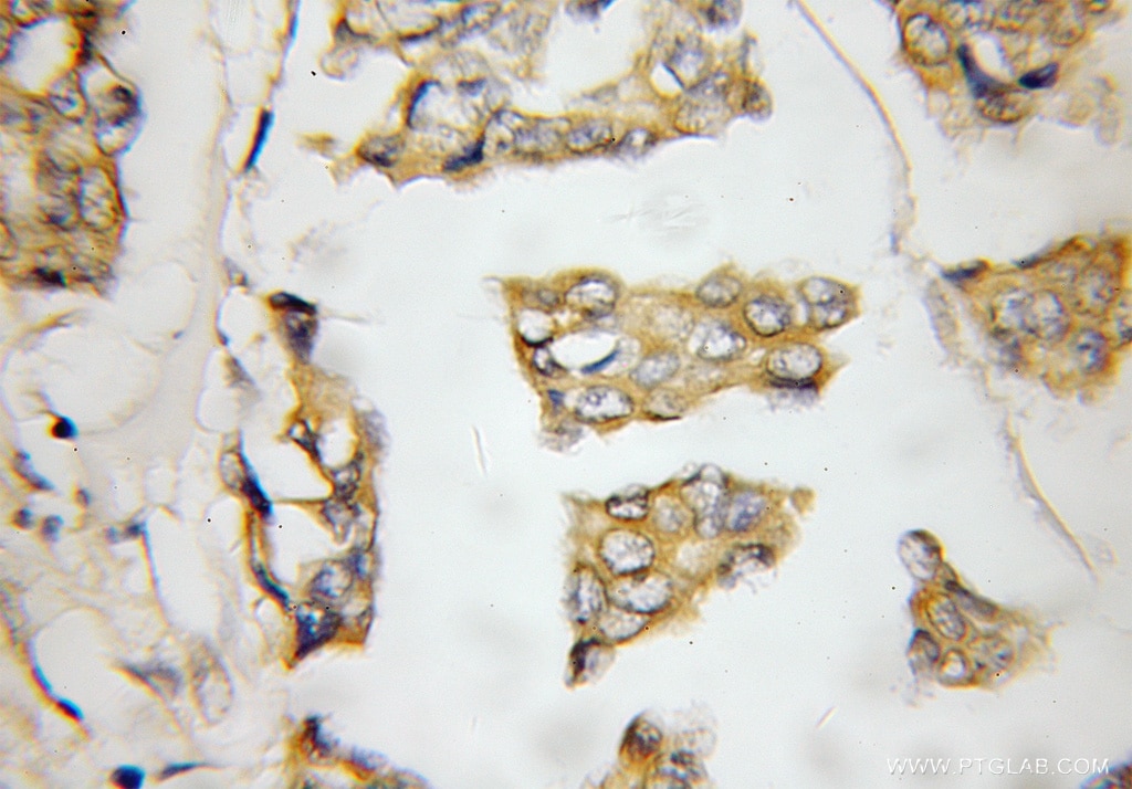 IHC staining of human breast cancer using 12217-1-AP