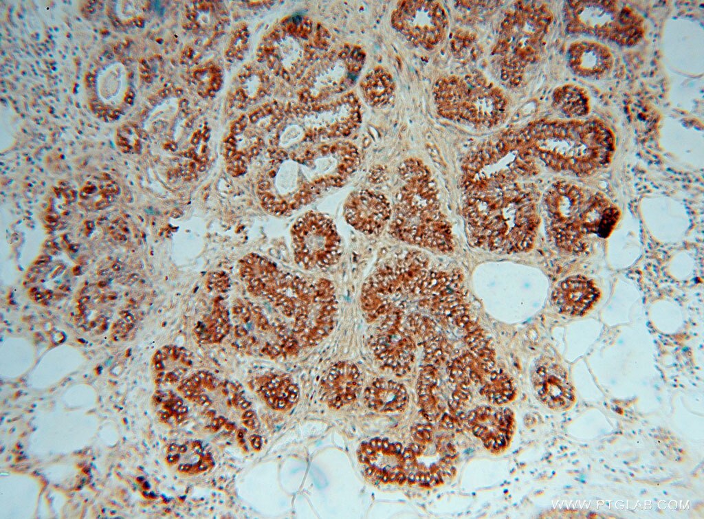 Immunohistochemistry (IHC) staining of human breast cancer tissue using CTHRC1 Polyclonal antibody (16534-1-AP)