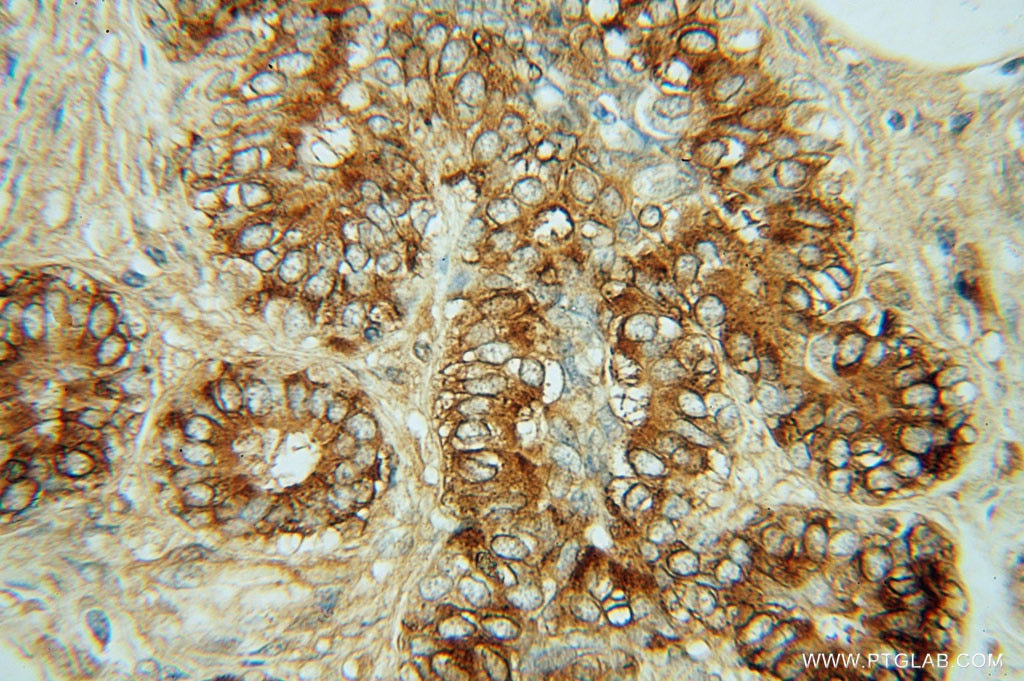 Immunohistochemistry (IHC) staining of human breast cancer tissue using CTHRC1 Polyclonal antibody (16534-1-AP)