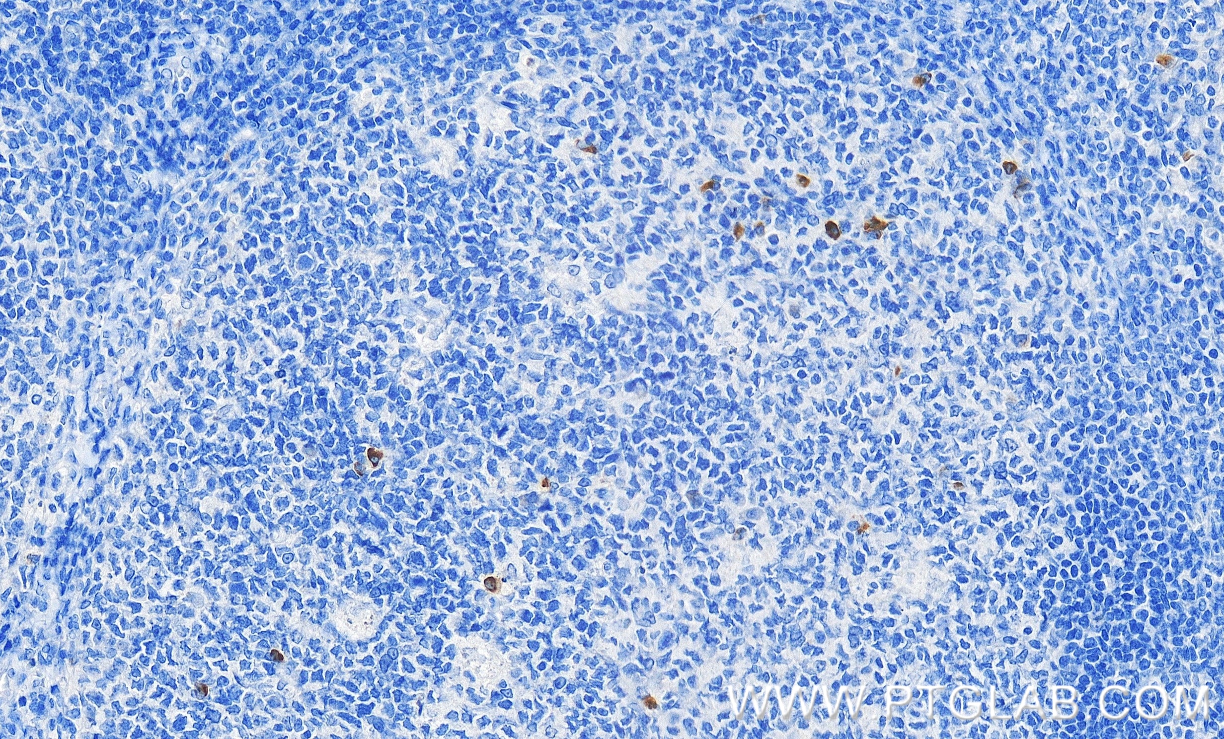Immunohistochemical analysis of paraffin-embedded human tonsillitis tissue slide using 98078-1-RR (CTLA-4/CD152 antibody) at dilution of 1:1000 (under 40x lens). Heat mediated antigen retrieval with Tris-EDTA buffer (pH 9.0). This data was developed using the same antibody clone with 98078-1-PBS in a different storage buffer formulation. Immunohistochemistry (IHC) staining of human tonsillitis tissue using Anti-Human CTLA-4/CD152 Rabbit Recombinant Antibod (98078-1-RR)