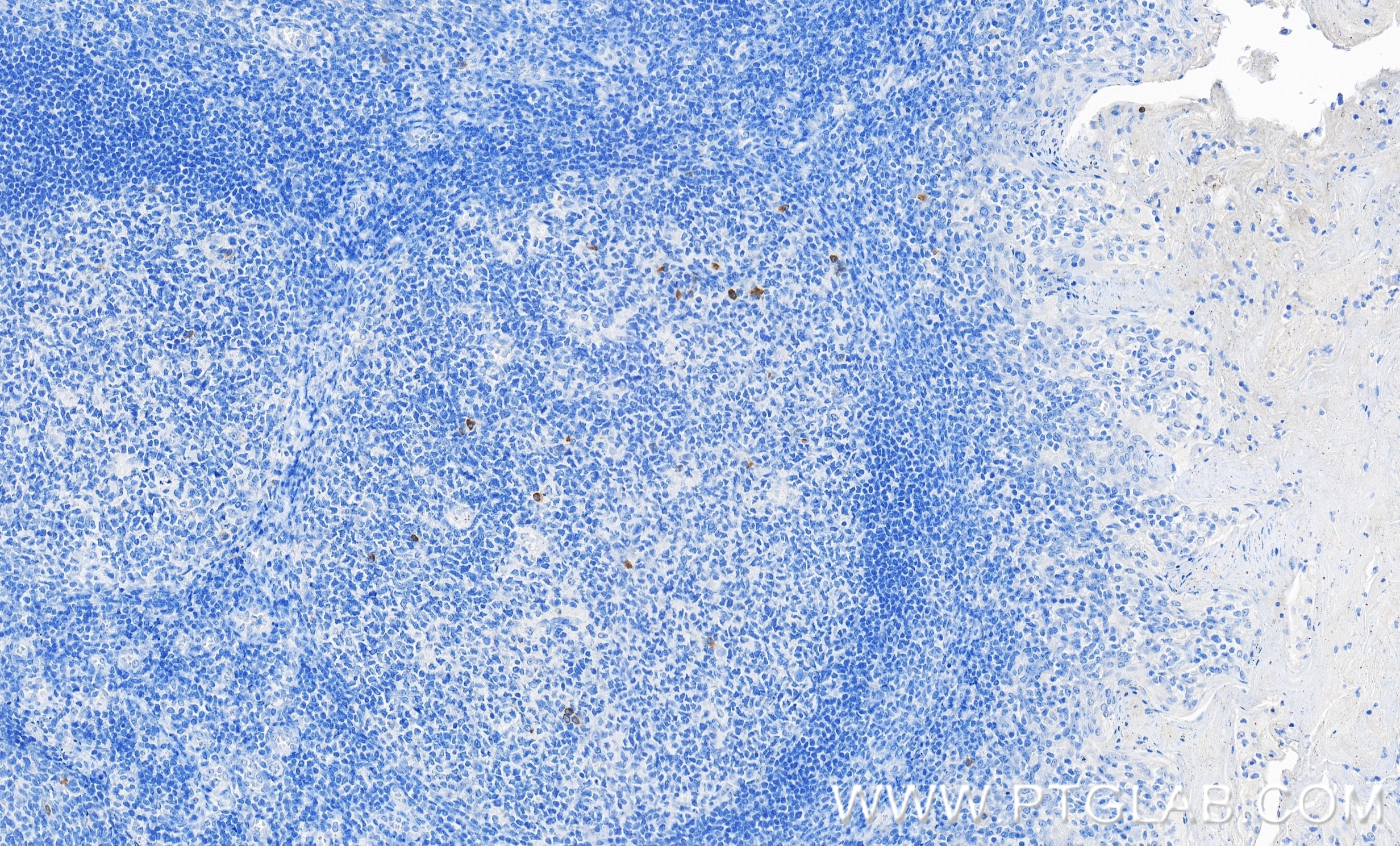 Immunohistochemical analysis of paraffin-embedded human tonsillitis tissue slide using 98078-1-RR (CTLA-4/CD152 antibody) at dilution of 1:1000 (under 20x lens). Heat mediated antigen retrieval with Tris-EDTA buffer (pH 9.0). This data was developed using the same antibody clone with 98078-1-PBS in a different storage buffer formulation. Immunohistochemistry (IHC) staining of human tonsillitis tissue using Anti-Human CTLA-4/CD152 Rabbit Recombinant Antibod (98078-1-RR)