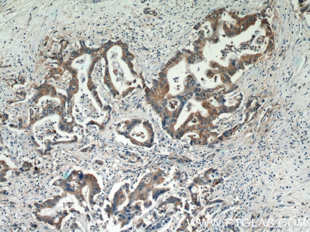 Immunohistochemistry (IHC) staining of human pancreas cancer tissue using Alpha E-Catenin Polyclonal antibody (12831-1-AP)