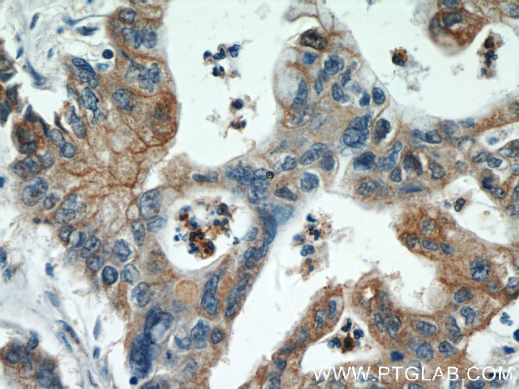 Immunohistochemistry (IHC) staining of human pancreas cancer tissue using Alpha E-Catenin Polyclonal antibody (12831-1-AP)