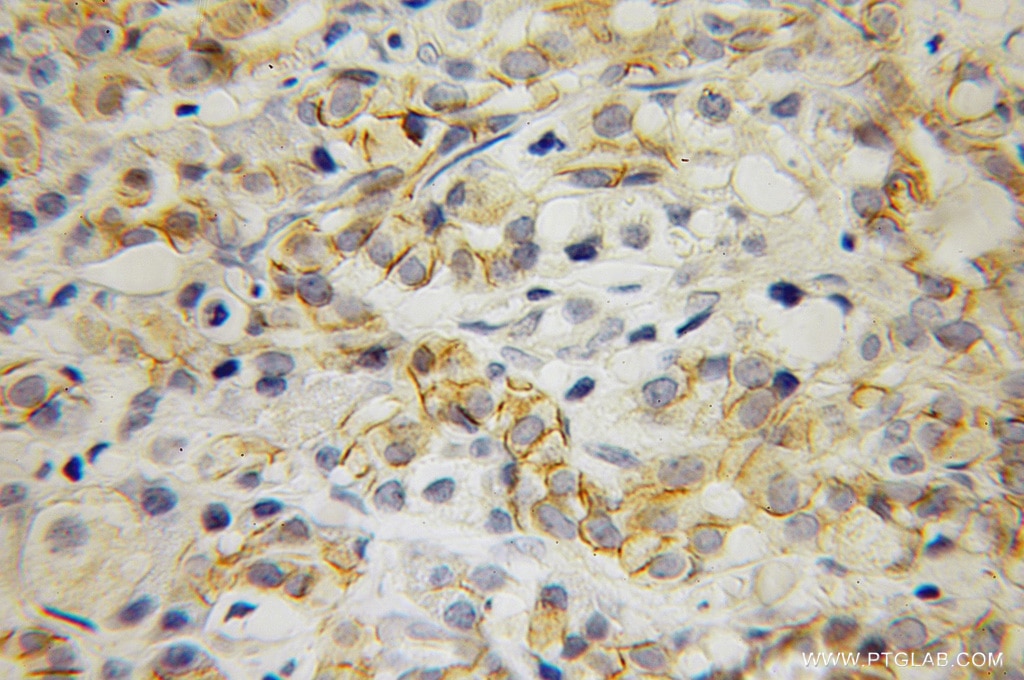IHC staining of human pancreas cancer using 12831-1-AP