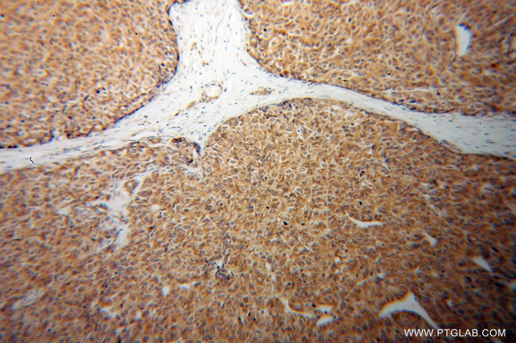 Immunohistochemistry (IHC) staining of human liver cancer tissue using CTNNA3 Polyclonal antibody (13974-1-AP)