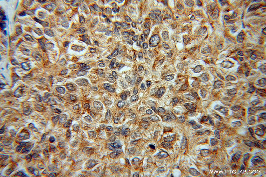 Immunohistochemistry (IHC) staining of human liver cancer tissue using CTNNA3 Polyclonal antibody (13974-1-AP)