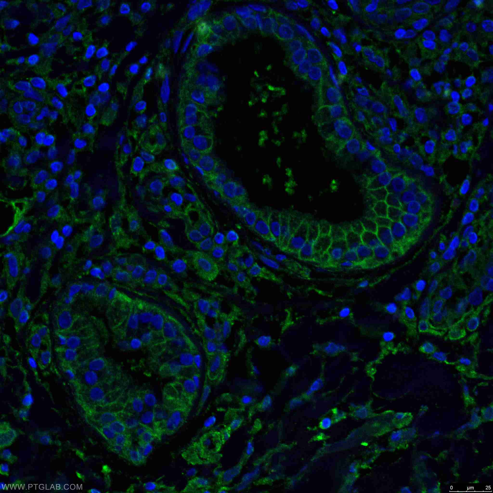Immunofluorescence (IF) / fluorescent staining of human skin cancer tissue using Beta Catenin Monoclonal antibody (66379-1-Ig)