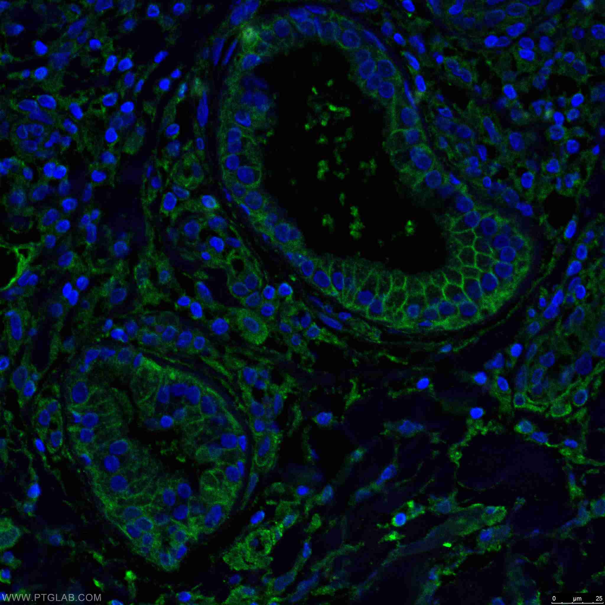 IF Staining of human skin cancer using 66379-1-Ig