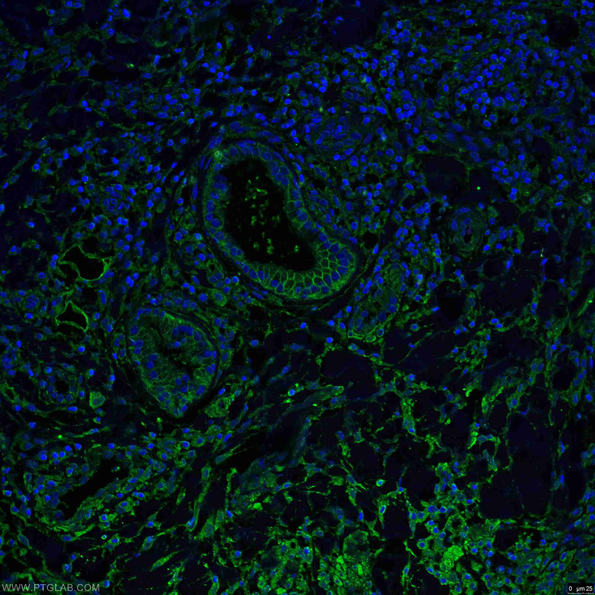 Immunofluorescence (IF) / fluorescent staining of human skin cancer tissue using Beta Catenin Monoclonal antibody (66379-1-Ig)