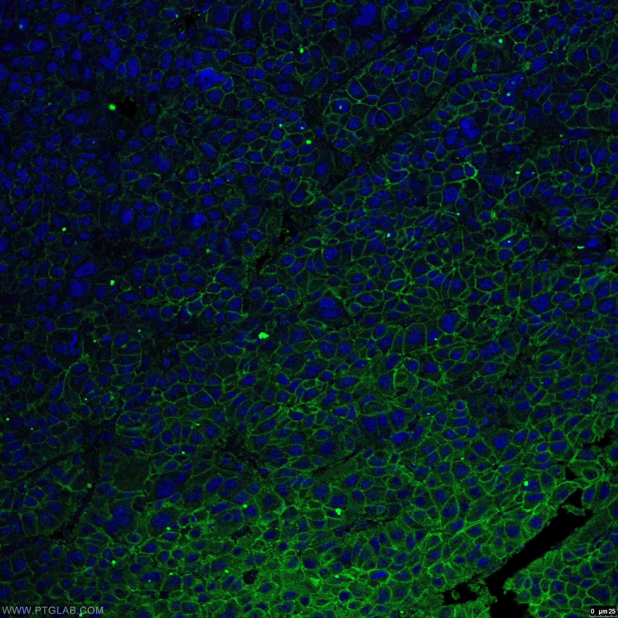 Immunofluorescence (IF) / fluorescent staining of human liver cancer tissue using Beta Catenin Monoclonal antibody (66379-1-Ig)