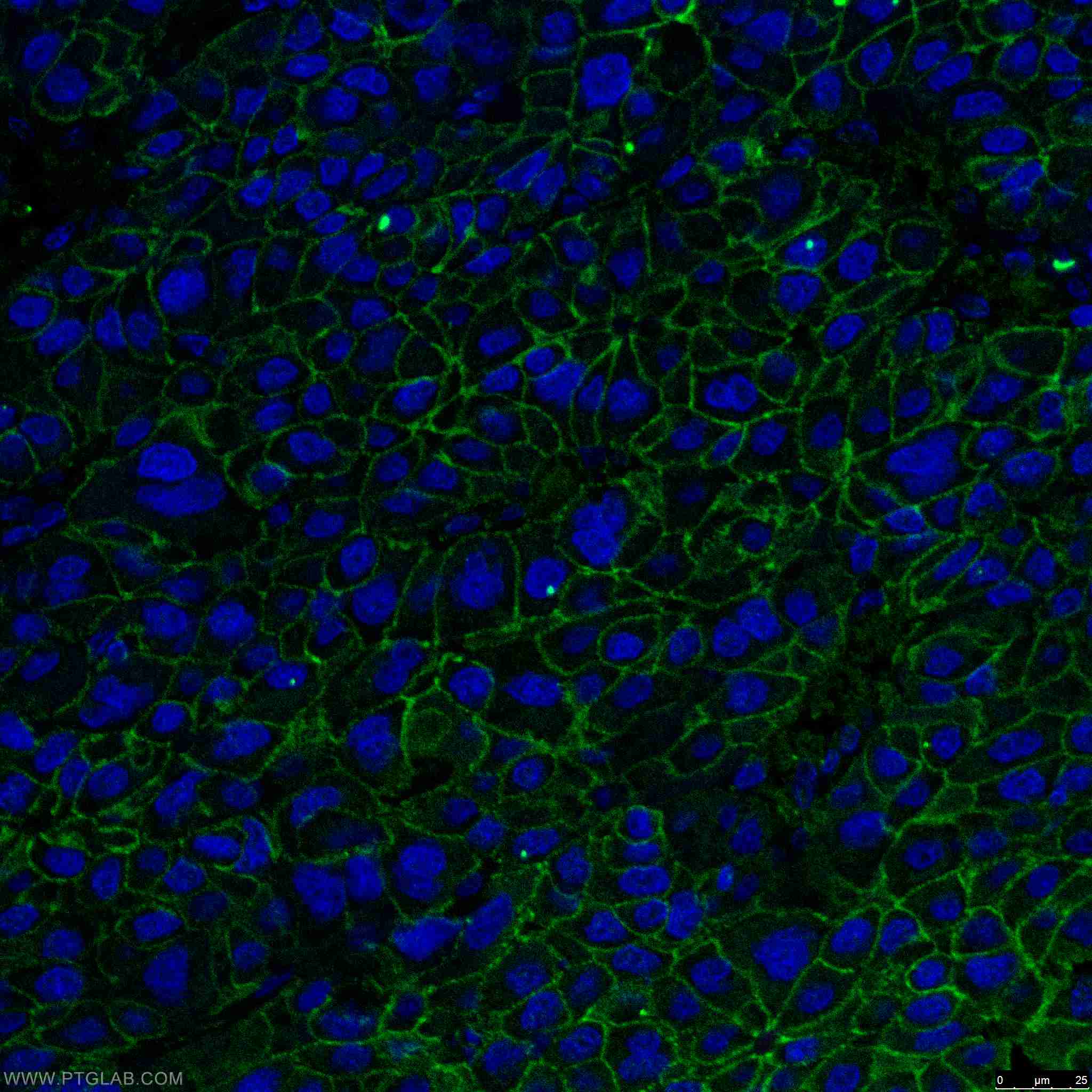 Immunofluorescence (IF) / fluorescent staining of human liver cancer tissue using Beta Catenin Monoclonal antibody (66379-1-Ig)