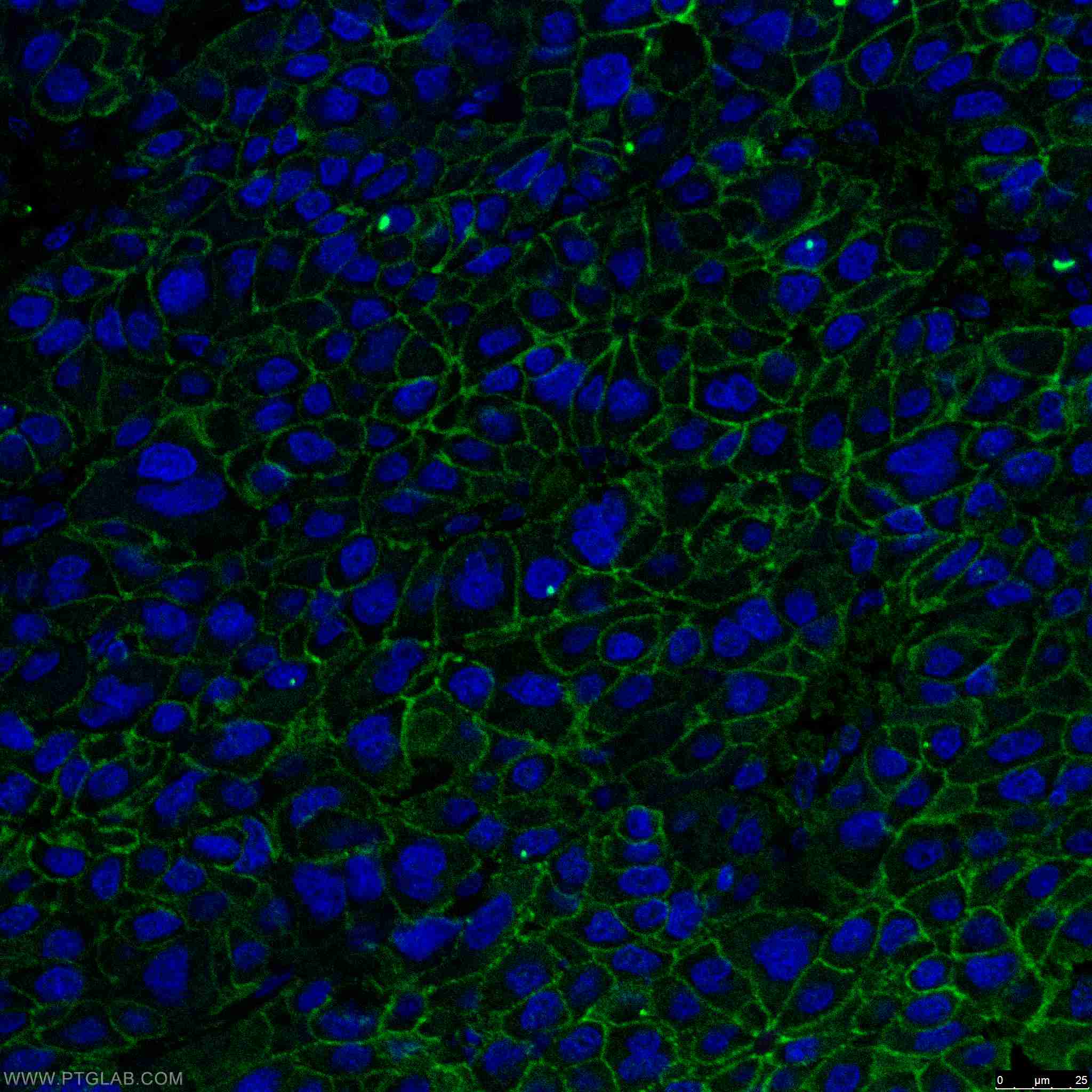 Immunofluorescence (IF) / fluorescent staining of human liver cancer tissue using Beta Catenin Monoclonal antibody (66379-1-Ig)