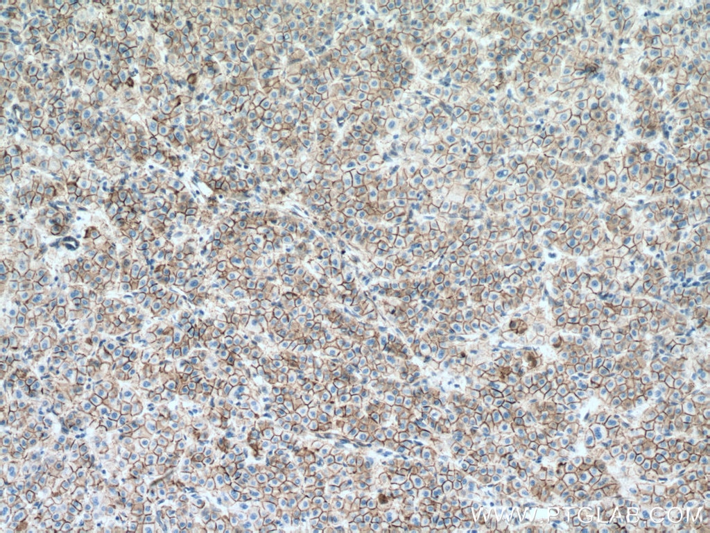 Immunohistochemistry (IHC) staining of human liver cancer tissue using Beta Catenin Monoclonal antibody (66379-1-Ig)