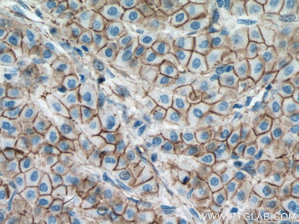 IHC staining of human liver cancer using 66379-1-Ig