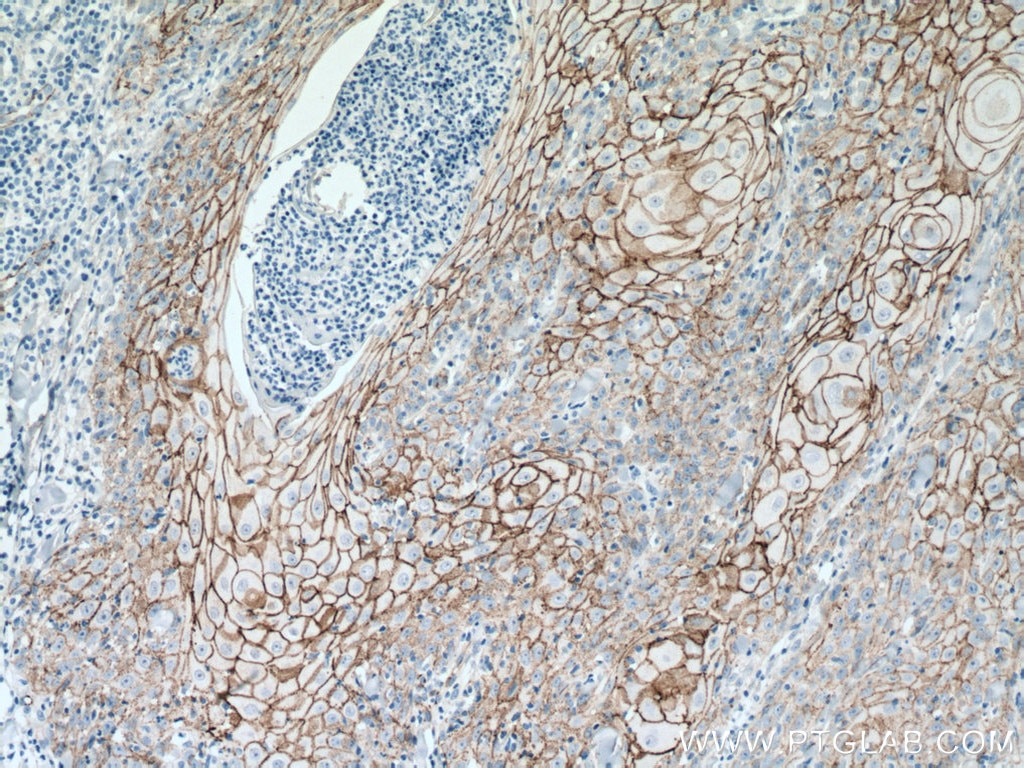 Immunohistochemistry (IHC) staining of human skin cancer tissue using Beta Catenin Monoclonal antibody (66379-1-Ig)