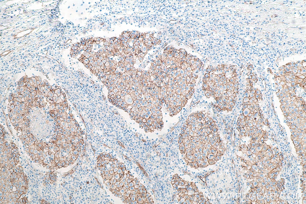 IHC staining of human breast cancer using 66379-1-Ig (same clone as 66379-1-PBS) Immunohistochemistry (IHC) staining of human breast cancer tissue using Beta Catenin Monoclonal antibody (66379-1-Ig)
