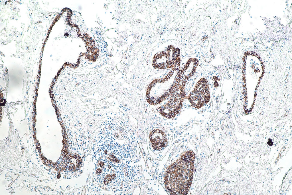 Immunohistochemistry (IHC) staining of human breast cancer tissue using Beta Catenin Monoclonal antibody (66379-1-Ig)