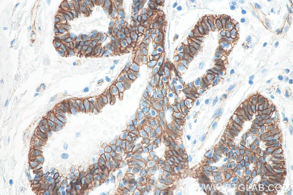 Immunohistochemistry (IHC) staining of human breast cancer tissue using Beta Catenin Monoclonal antibody (66379-1-Ig)