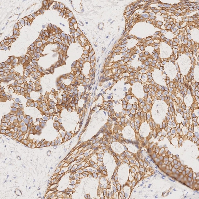 Immunohistochemistry (IHC) staining of human breast cancer tissue using Beta Catenin Monoclonal antibody (66379-1-Ig)