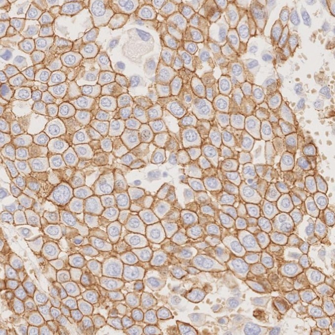 Immunohistochemistry (IHC) staining of human liver cancer tissue using Beta Catenin Monoclonal antibody (66379-1-Ig)
