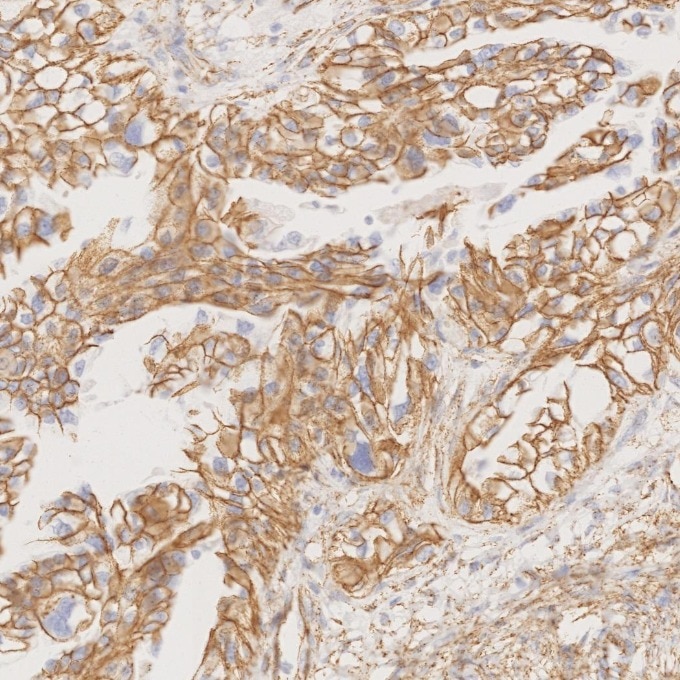 Immunohistochemistry (IHC) staining of human ovary cancer tissue using Beta Catenin Monoclonal antibody (66379-1-Ig)