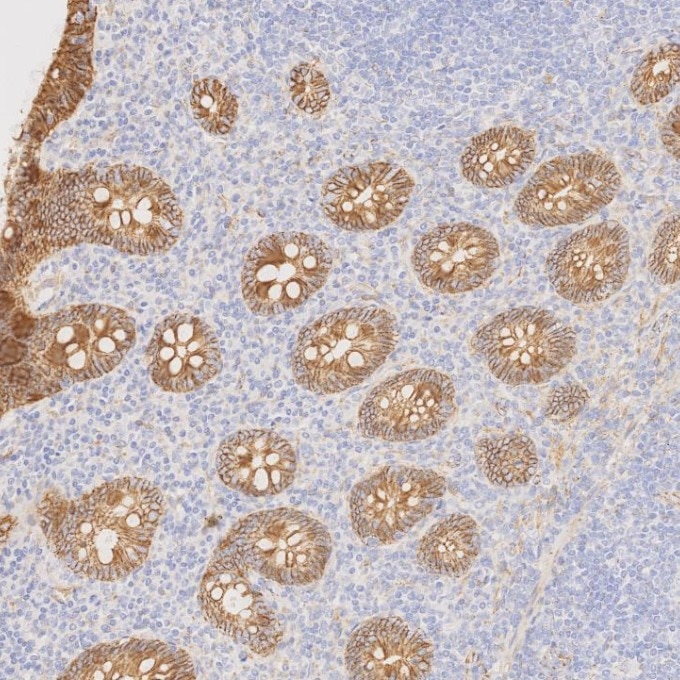 Immunohistochemistry (IHC) staining of human appendicitis tissue using Beta Catenin Monoclonal antibody (66379-1-Ig)