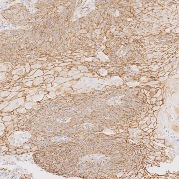 Immunohistochemistry (IHC) staining of human cervical cancer tissue using Beta Catenin Monoclonal antibody (66379-1-Ig)