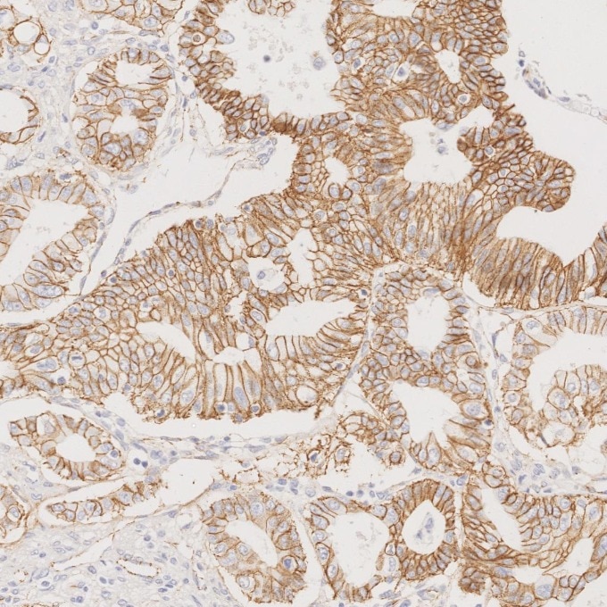 Immunohistochemistry (IHC) staining of human pancreas cancer tissue using Beta Catenin Monoclonal antibody (66379-1-Ig)