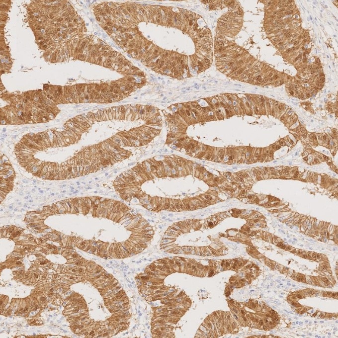 Immunohistochemistry (IHC) staining of human colorectal cancer tissue using Beta Catenin Monoclonal antibody (66379-1-Ig)