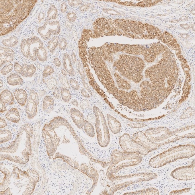 Immunohistochemistry (IHC) staining of human stomach cancer tissue using Beta Catenin Monoclonal antibody (66379-1-Ig)