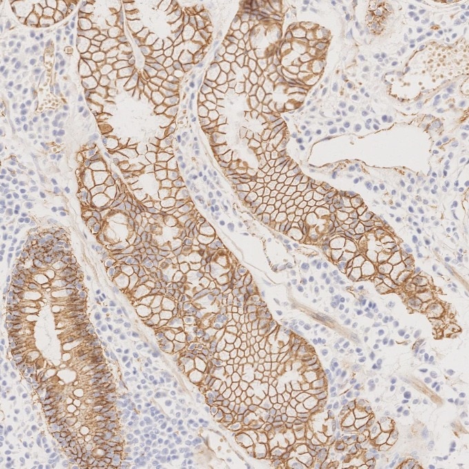 Immunohistochemistry (IHC) staining of human stomach cancer tissue using Beta Catenin Monoclonal antibody (66379-1-Ig)