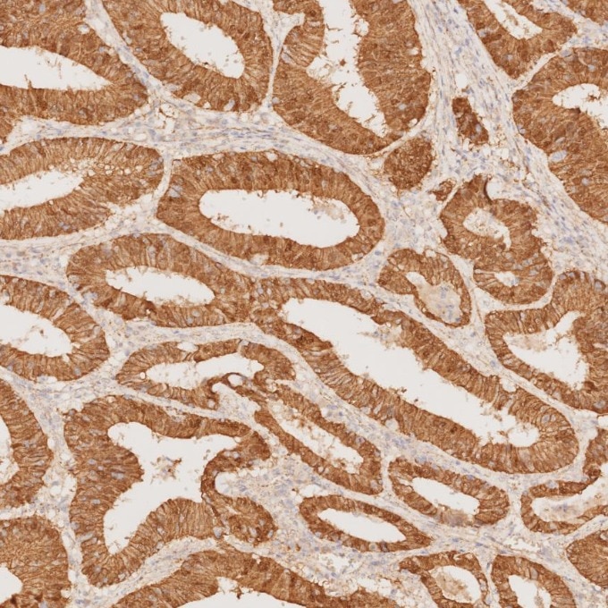 Immunohistochemistry (IHC) staining of human colorectal cancer tissue using Beta Catenin Monoclonal antibody (66379-1-Ig)