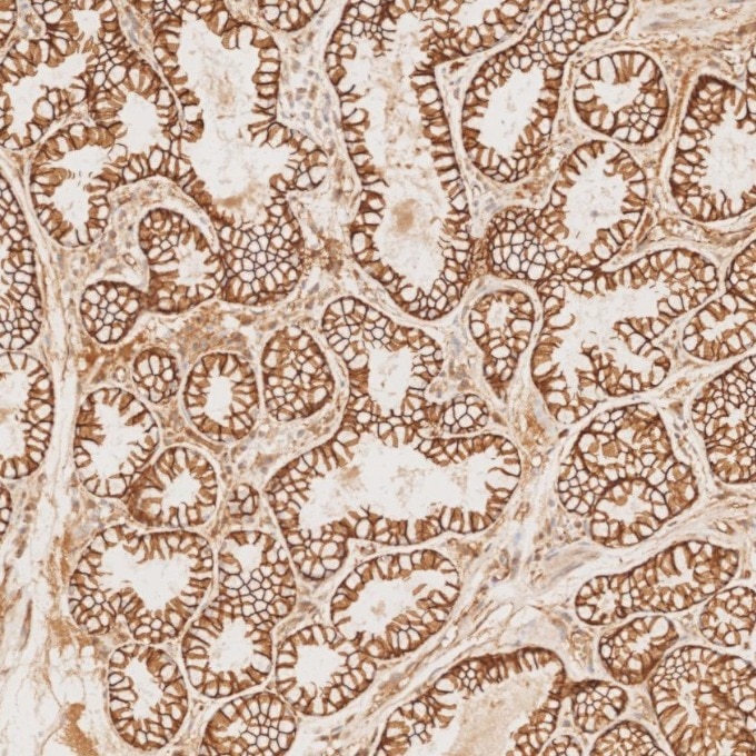 Immunohistochemistry (IHC) staining of human stomach cancer tissue using Beta Catenin Monoclonal antibody (66379-1-Ig)