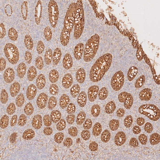 Immunohistochemistry (IHC) staining of human appendicitis tissue using Beta Catenin Monoclonal antibody (66379-1-Ig)