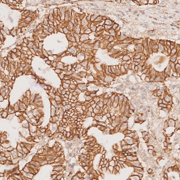Immunohistochemistry (IHC) staining of human pancreas cancer tissue using Beta Catenin Monoclonal antibody (66379-1-Ig)