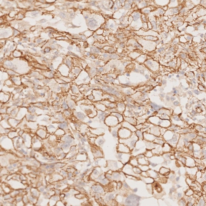 Immunohistochemistry (IHC) staining of human ovary cancer tissue using Beta Catenin Monoclonal antibody (66379-1-Ig)