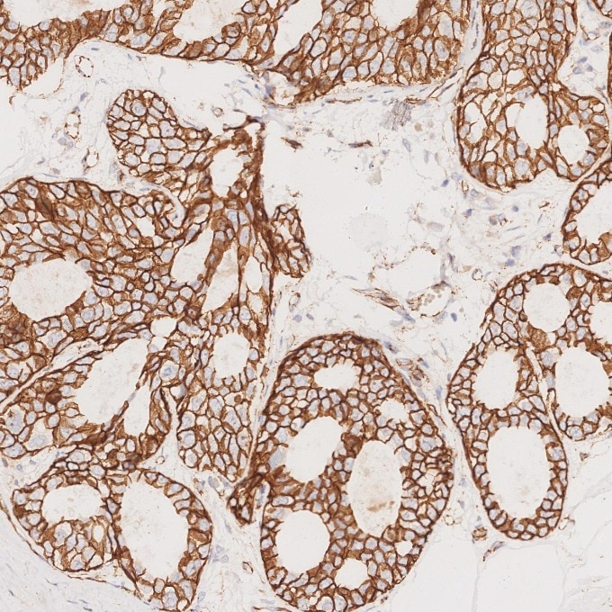 Immunohistochemistry (IHC) staining of human breast cancer tissue using Beta Catenin Monoclonal antibody (66379-1-Ig)
