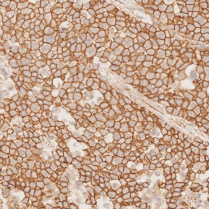Immunohistochemistry (IHC) staining of human liver cancer tissue using Beta Catenin Monoclonal antibody (66379-1-Ig)