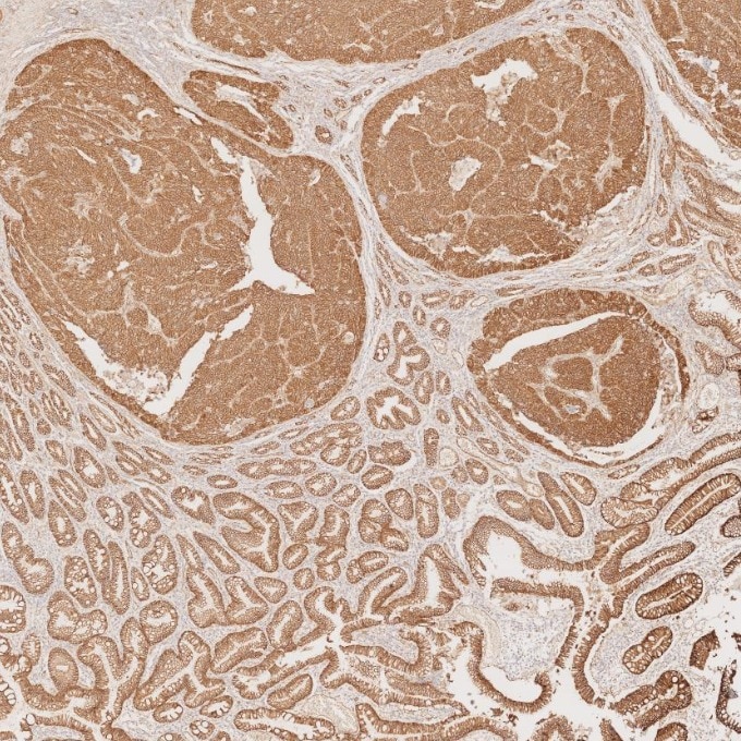 Immunohistochemistry (IHC) staining of human stomach cancer tissue using Beta Catenin Monoclonal antibody (66379-1-Ig)
