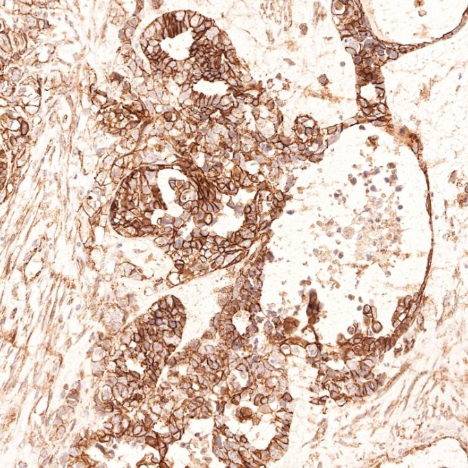 Immunohistochemistry (IHC) staining of human ovary cancer tissue using Beta Catenin Monoclonal antibody (66379-1-Ig)