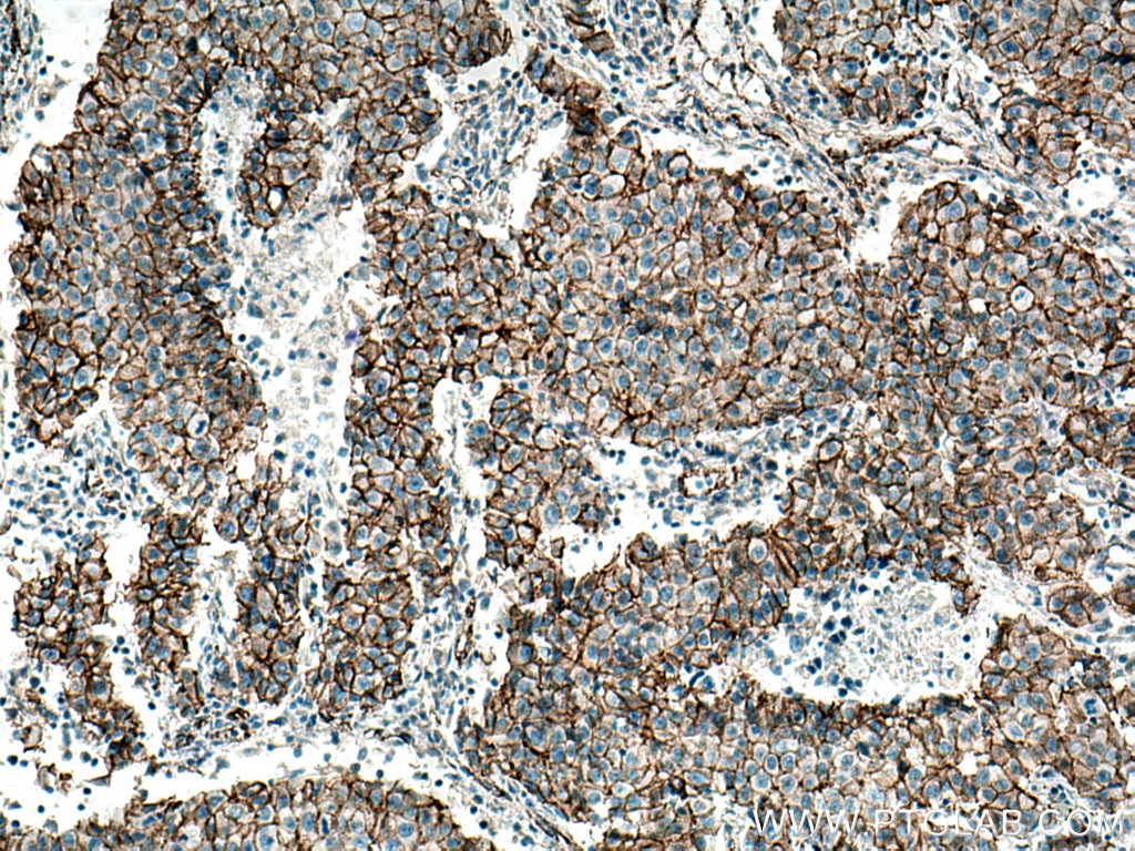 Immunohistochemistry (IHC) staining of human breast cancer tissue using p120 Catenin Polyclonal antibody (12180-1-AP)