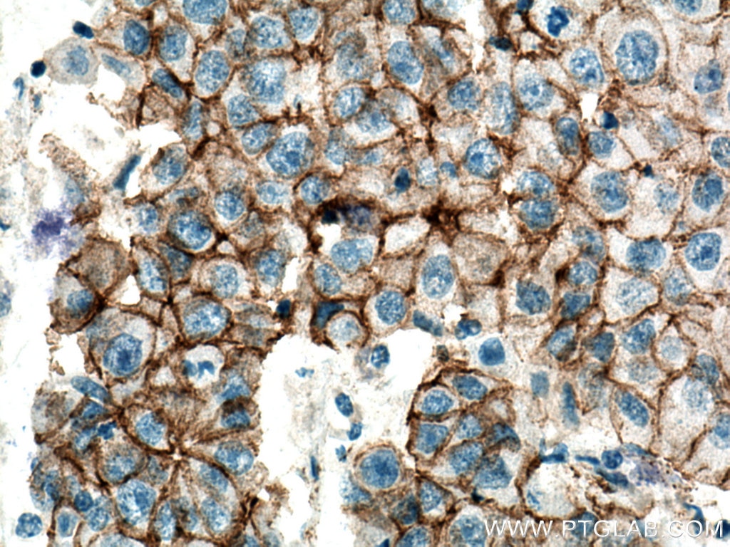 Immunohistochemistry (IHC) staining of human breast cancer tissue using p120 Catenin Polyclonal antibody (12180-1-AP)