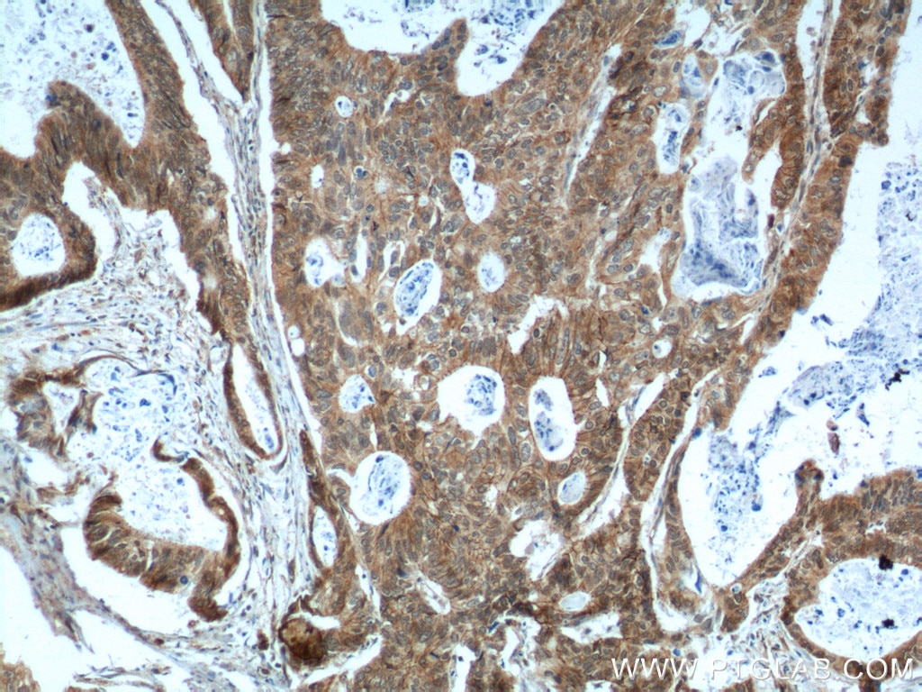 Immunohistochemistry (IHC) staining of human colon cancer tissue using p120 Catenin Polyclonal antibody (12180-1-AP)